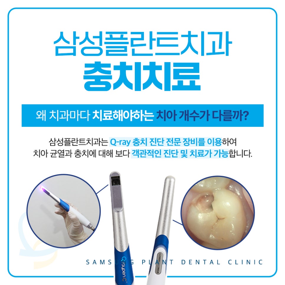 양천구치과 표면 충치 예방 처치와 간단 수복 치료 비교 선택 기준 방법