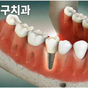 잇몸뼈 부족 여부를 양천구치과에서 확인하는 임플란트 상담