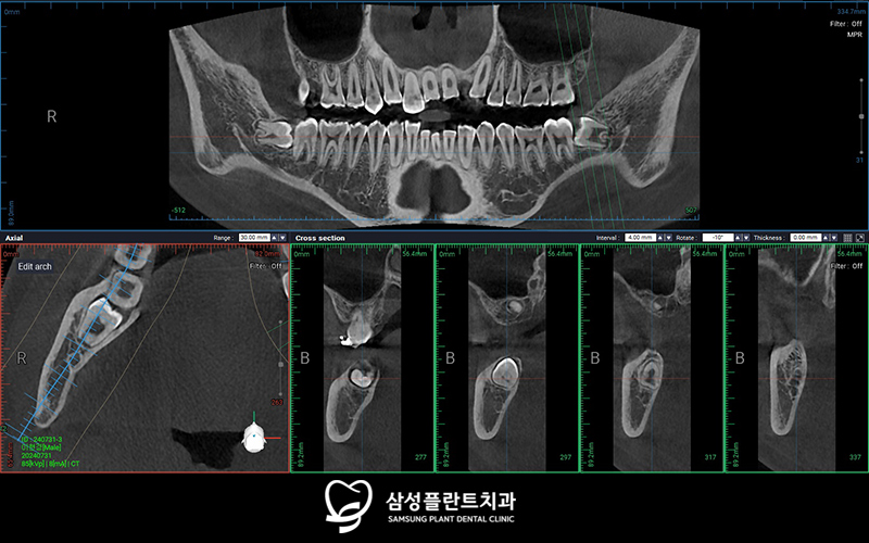 매복사랑니발치치과