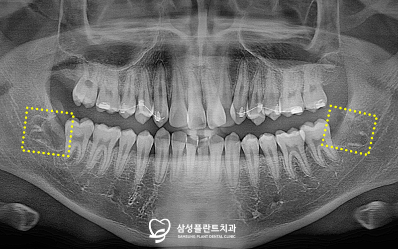 사랑니발치후주의사항