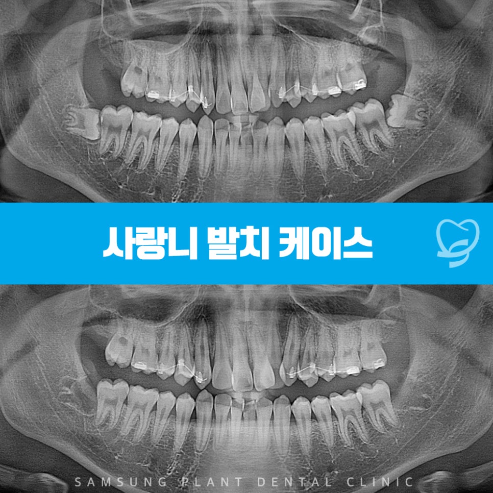 신정네거리역사랑니발치
