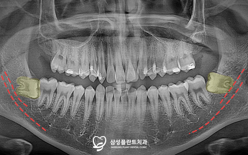 신정동사랑니발치치과