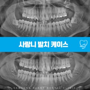 신정네거리역사랑니발치