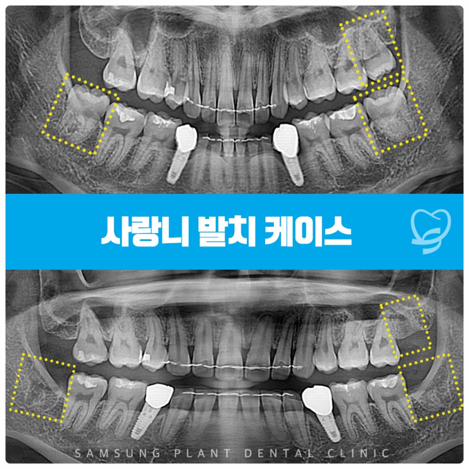 신정동사랑니발치잘하는곳