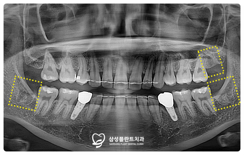 신정동사랑니염증발치