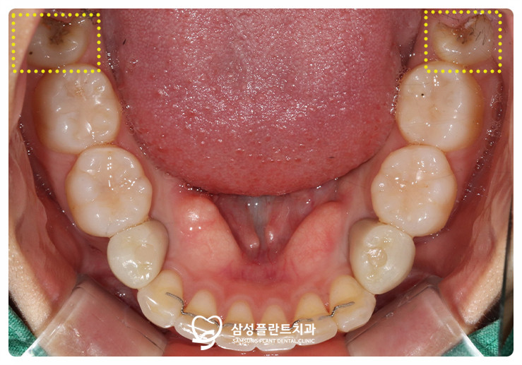 신정동사랑니치과추천