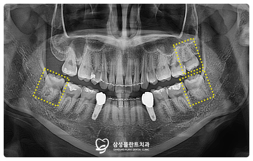 신정동아픈사랑니발치