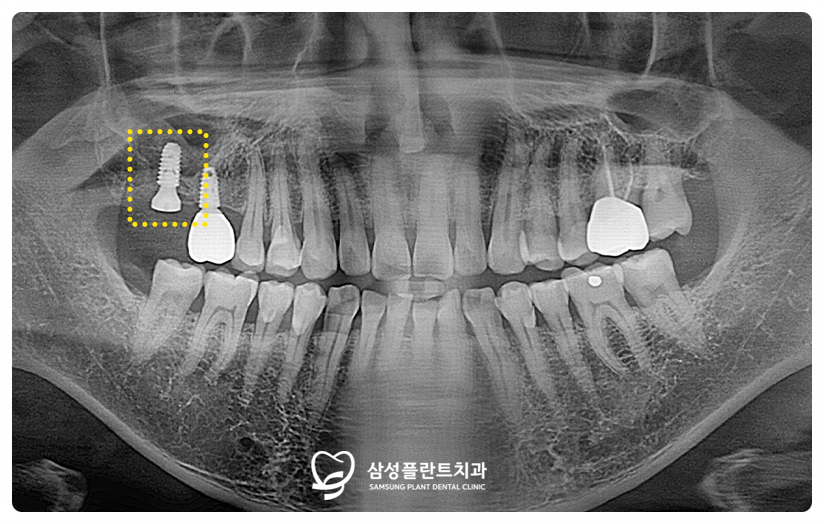 신정동앞니임플란트치과
