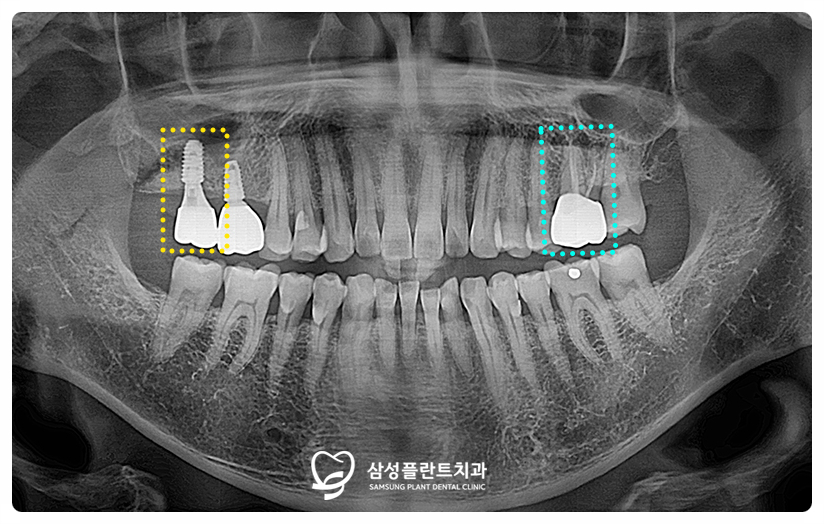 신정동어금니임플란트