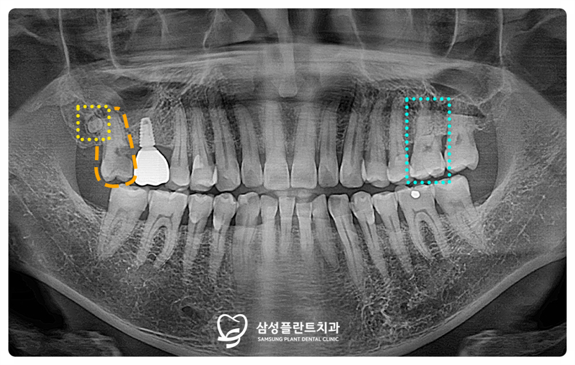 양천구치과재수술