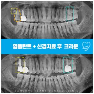 신정동임플란트잘하는곳