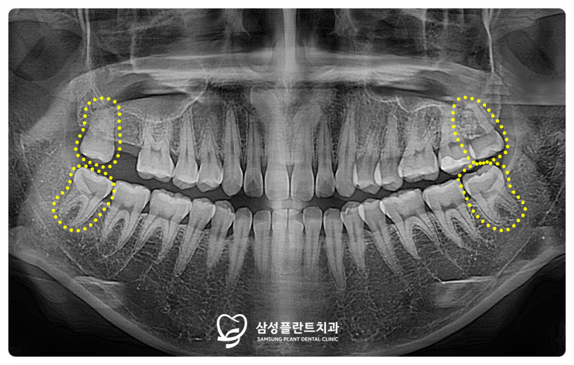 4개의 사랑니를 발치하기 전과 후의 구강 상태 비교