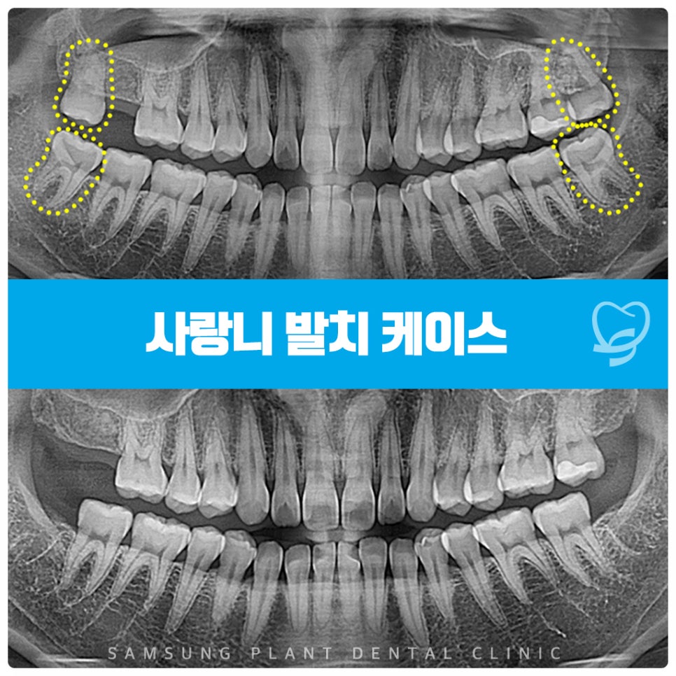 양천구사랑니 치료로 4개의 사랑니를 깔끔하게 발치한 사례