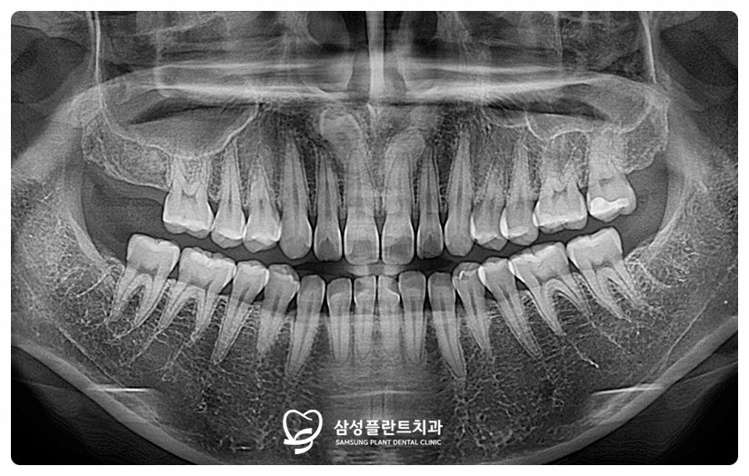 회복과 식사 여건을 고려해 오른쪽과 왼쪽을 나누어 진행한 발치