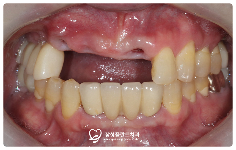 다른 곳에서 발치한 뒤 앞니 임플란트 상담을 위해 찾은 환자