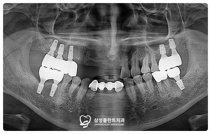 송곳니와 큰 앞니에 임플란트를 심는 브릿지 형태의 치료 계획