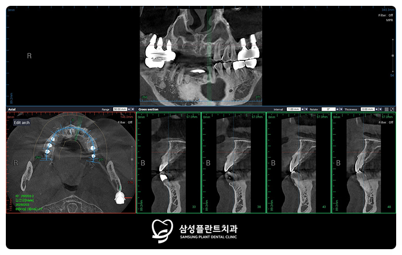 CT 촬영으로 상악동 위치와 잇몸뼈의 양을 살피는 단계