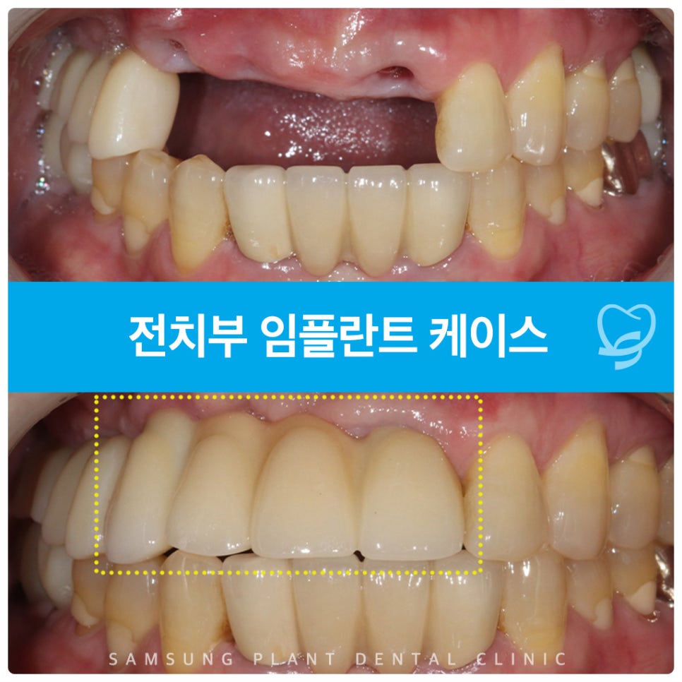 양천구치과에서 세심한 계획으로 완성한 앞니 임플란트