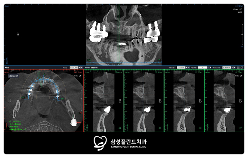임플란트 사이에 인공치아를 연결하도록 설계한 보철 구조