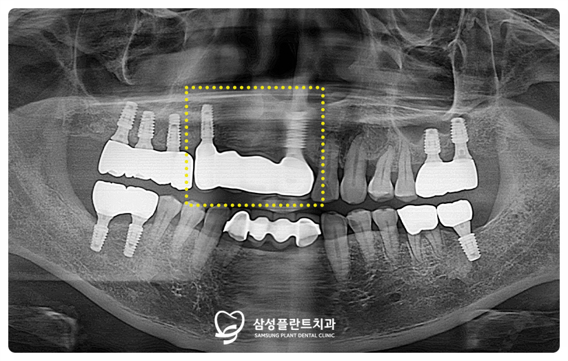 치료 기간 동안 식사와 일상의 불편을 덜어주는 임시 틀니