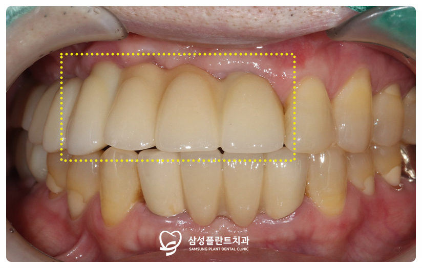 픽스처 유착을 확인한 뒤 크라운 보철물을 셋팅한 앞니