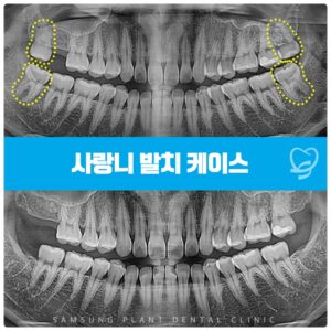 양천구사랑니 치료로 4개의 사랑니를 깔끔하게 발치한 사례