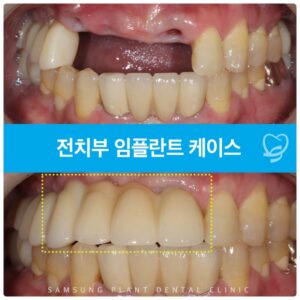 양천구치과에서 세심한 계획으로 완성한 앞니 임플란트